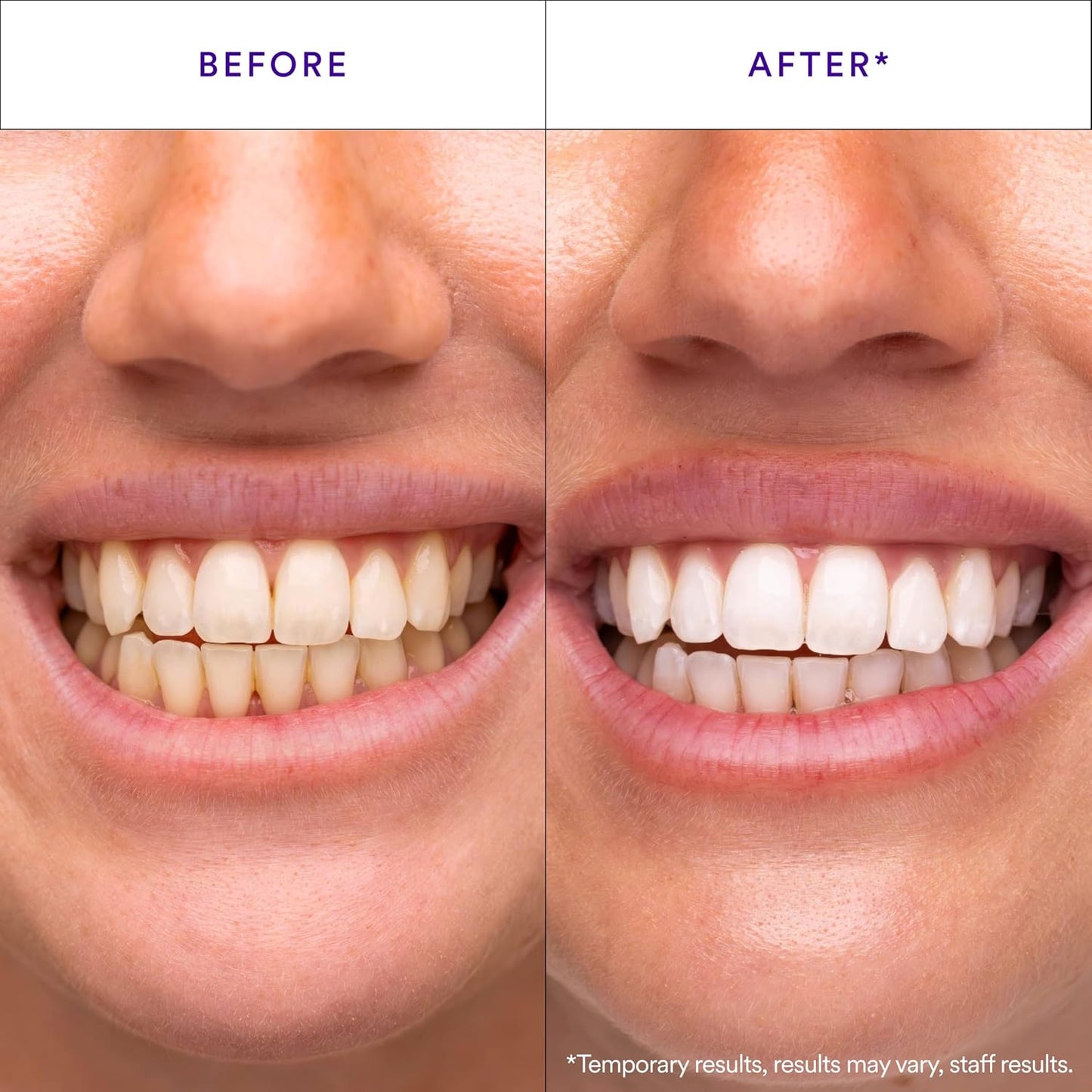 HISMILE | V34 WHITENING STRIPS