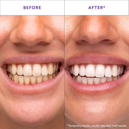 HISMILE | V34 WHITENING STRIPS