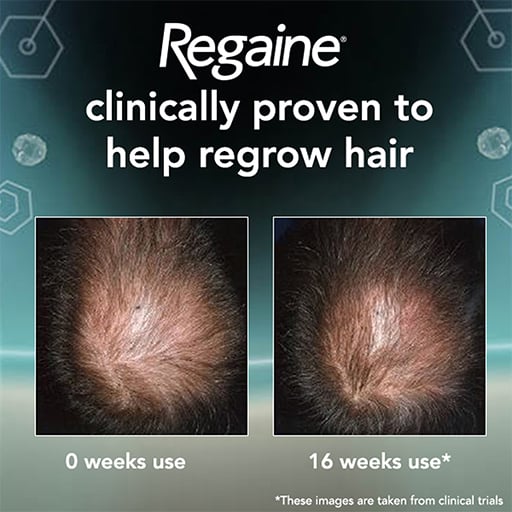 REGAINE FOR MEN | EXTRA STRENGTH SCALP FOAM FOR HAIR REGROWTH