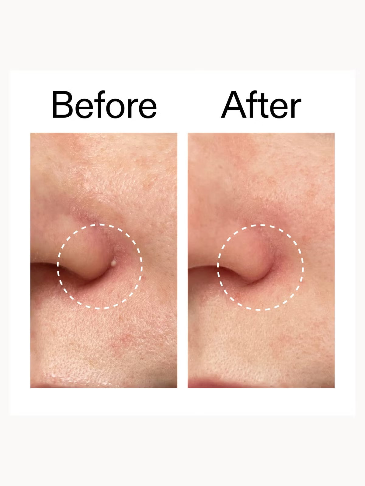 THE INKEY LIST | HYDROCOLLOID INVISIBLE PIMPLE PATCHES (22 PATCHES)